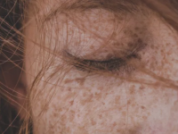 Skin Analytics获400万英镑融资 将AI用于皮肤癌筛查