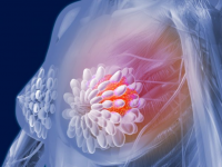 人工智能可能会改善阅读乳腺癌筛查的乳房X光照片